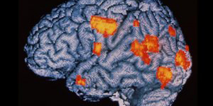 Ученые связали бессонницу с нарушением структуры мозга